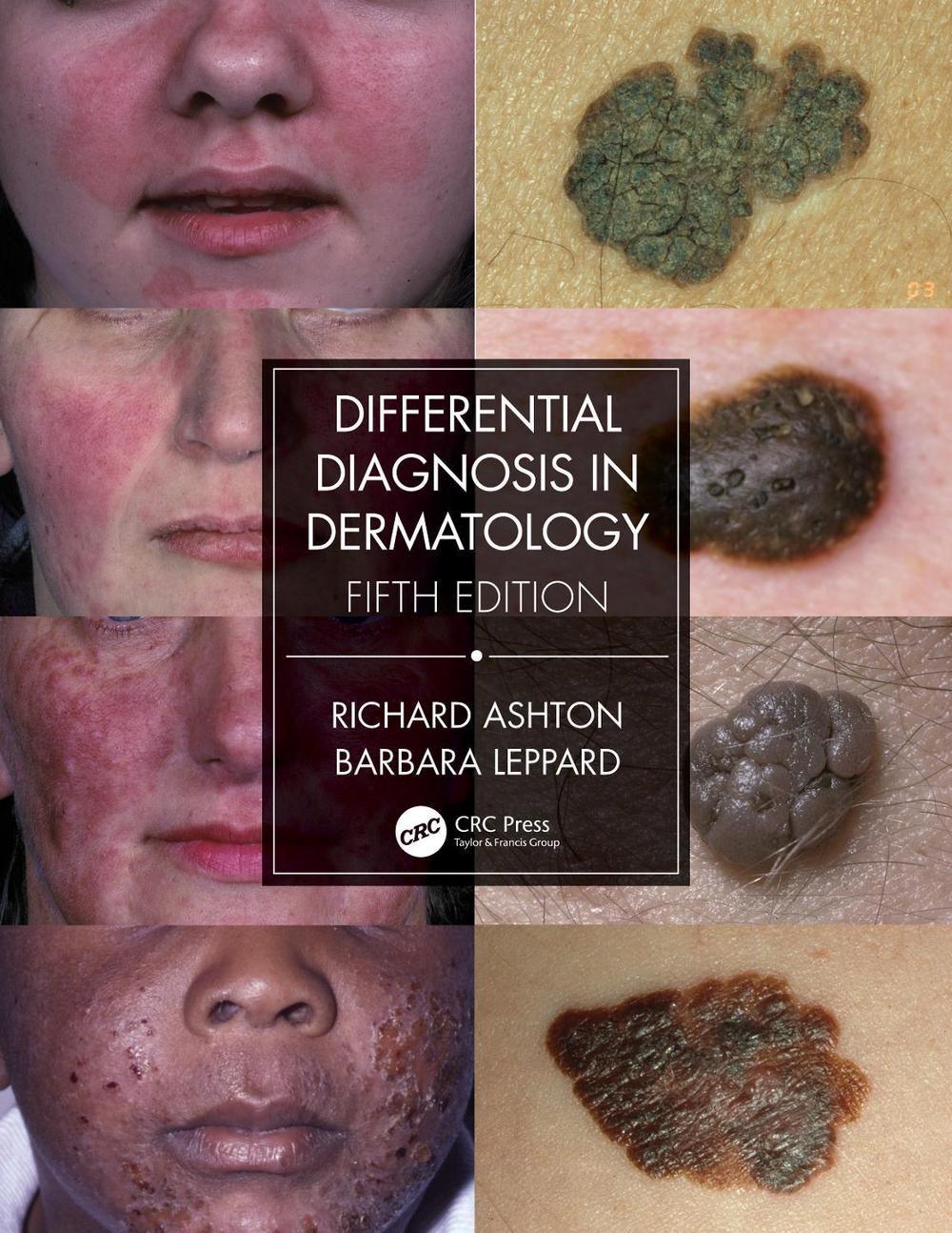 Differential Diagnosis in Dermatology, 5th Edition, 9780367085971