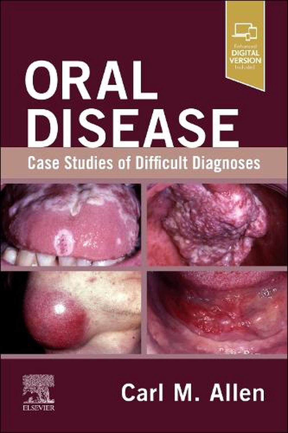 Oral Disease: Case Studies of Difficult Diagnoses by Carl M. Allen - ISBN: 9780443280900