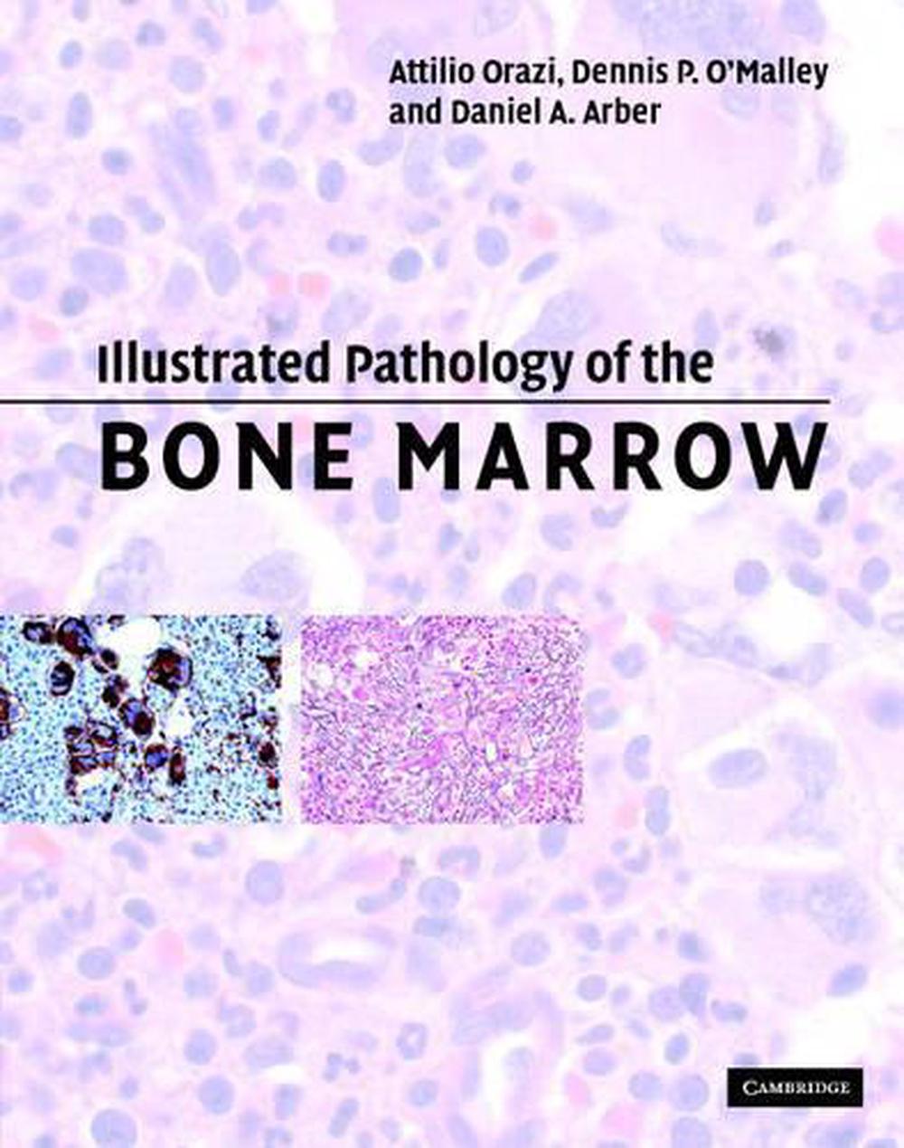 Illustrated Pathology of the Bone Marrow, 9780521810036