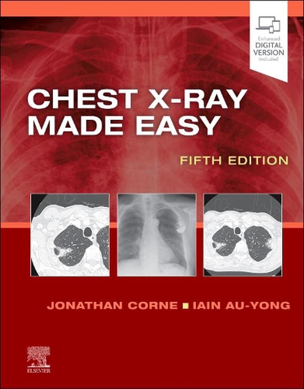Chest X-Ray Made Easy, 5th Edition, 9780702082344