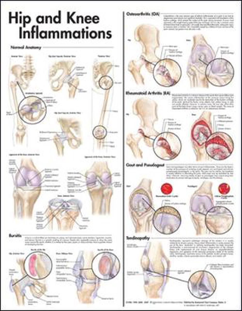 Hip and Knee Inflammations Anatomical Chart by Anatomical Chart Company