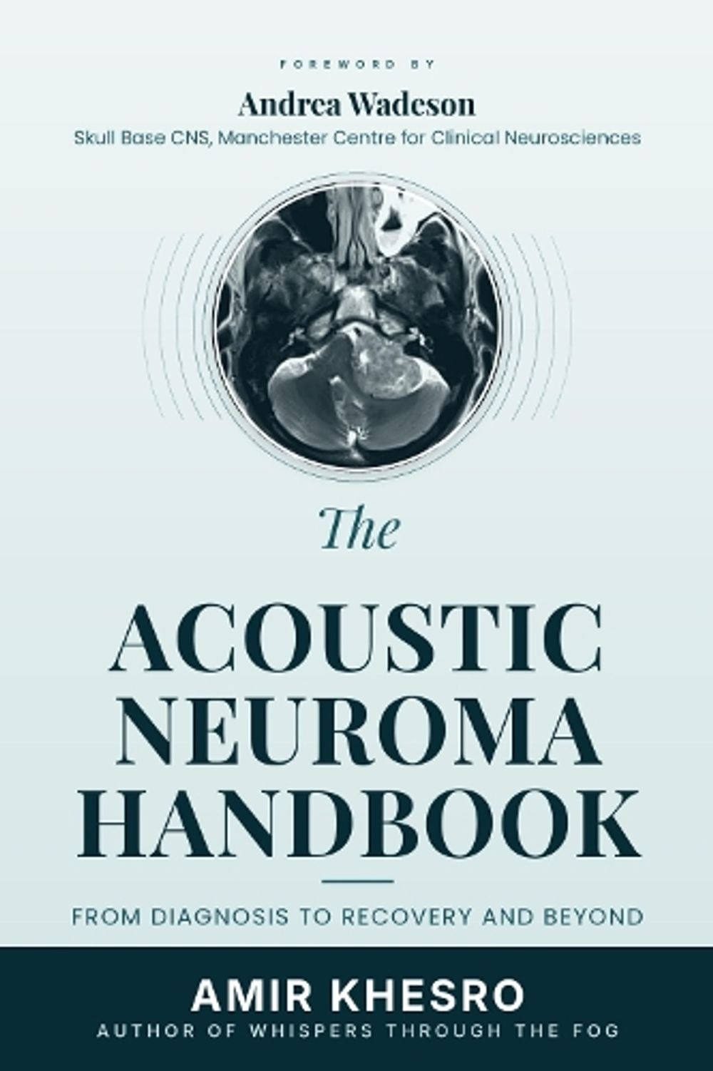 A THE ACOUSTIC NEUROMA (VESTIBULAR SCHWANNOMA) HANDBOOK by Amir Khesro - ISBN: 9781066798841