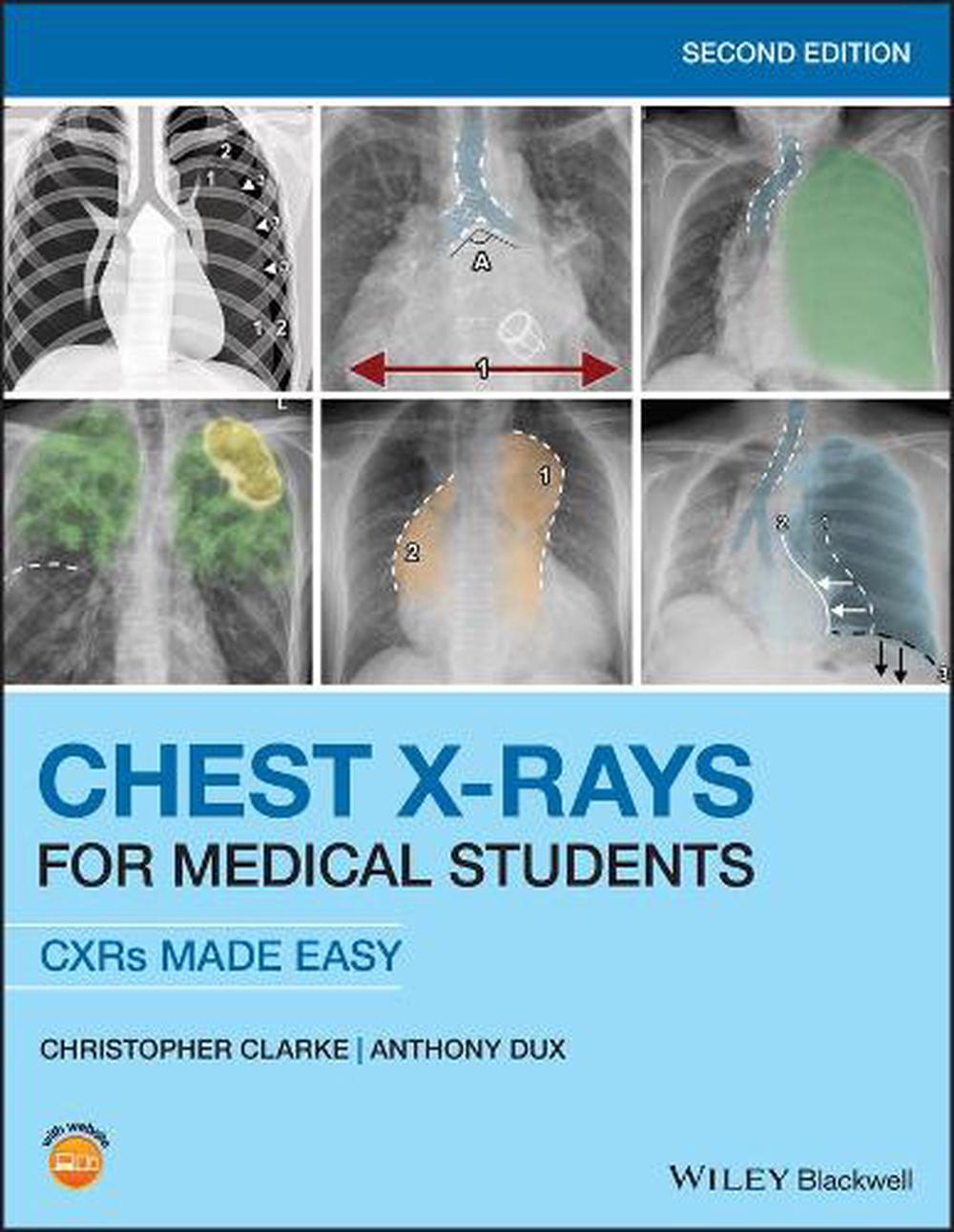 Chest X-Rays for Medical Students, 2nd Edition, 9781119504153