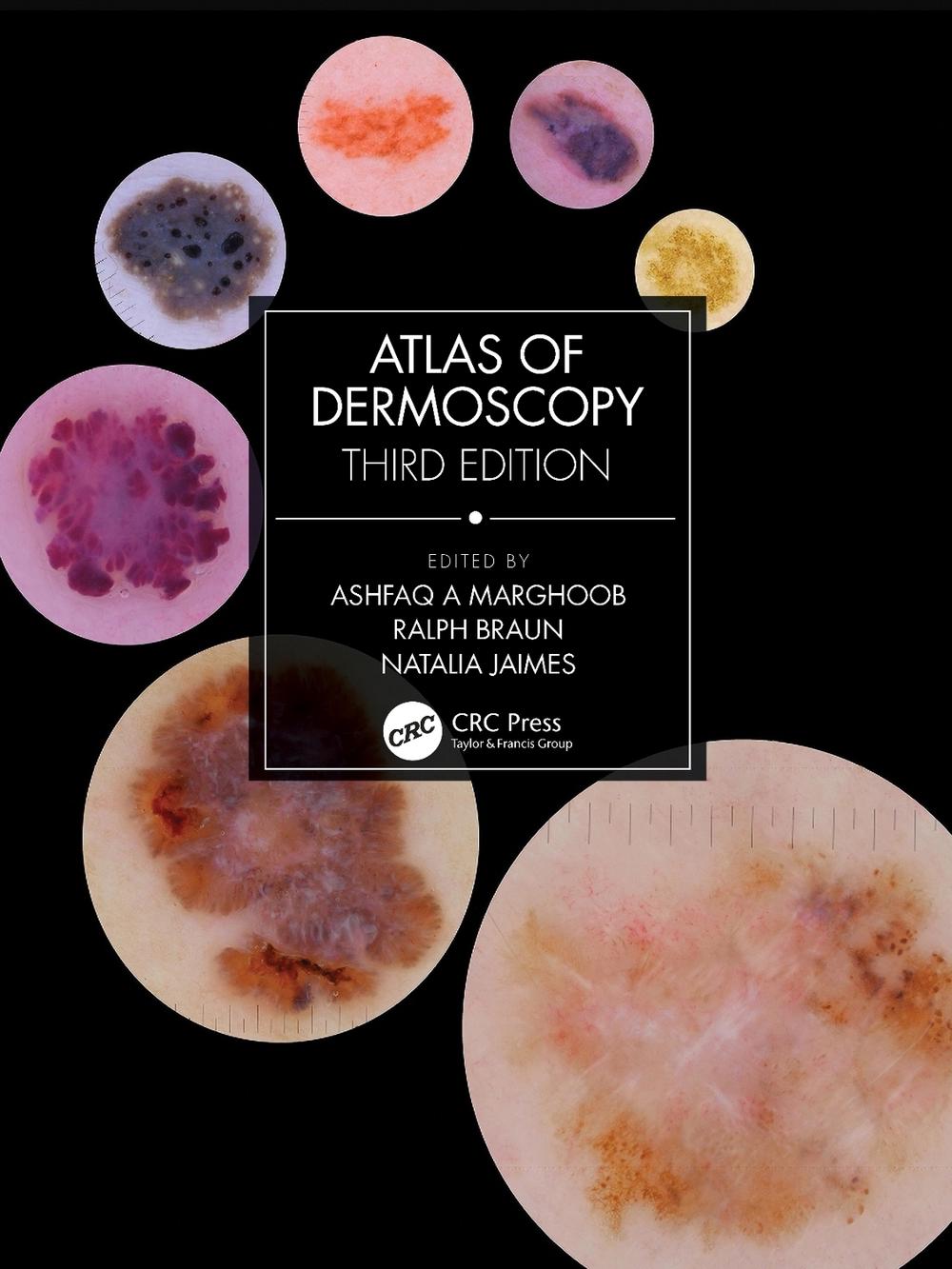 Atlas of Dermoscopy, 3rd Edition, 9781138595989