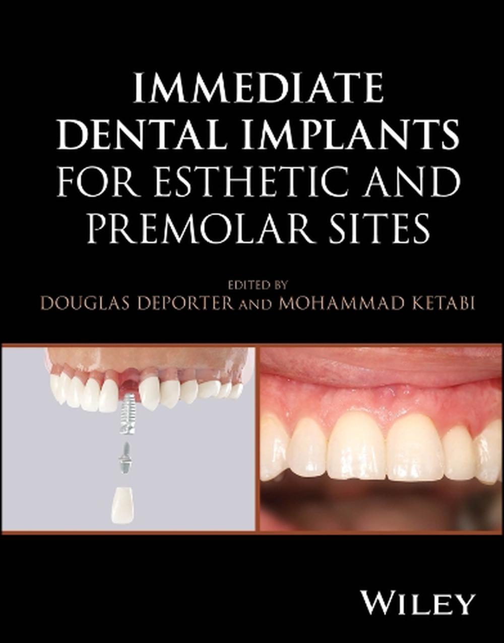 Immediate Dental Implants for Esthetic and Premolar Sites, 9781394187102