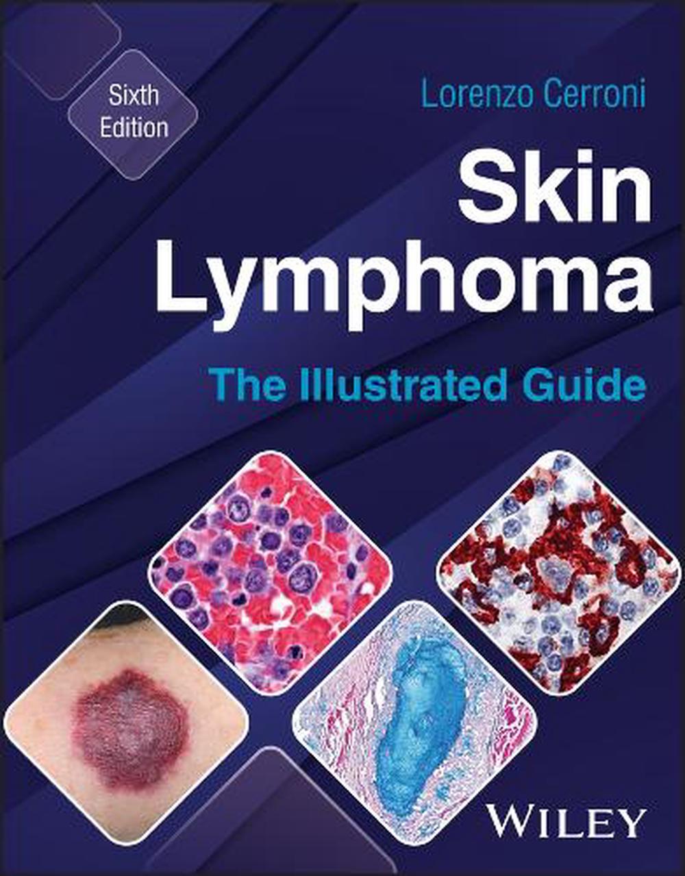 Skin Lymphoma, 9781394235483