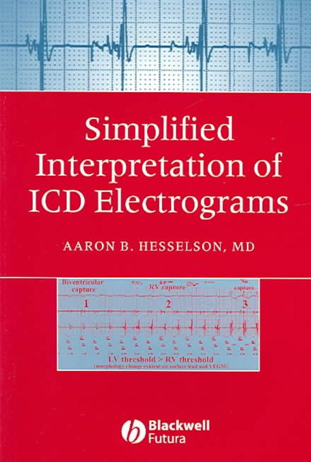 Alat Electrogram Simplified Interpretation of ICD Electrograms, 1st Edition by Aaron B ...