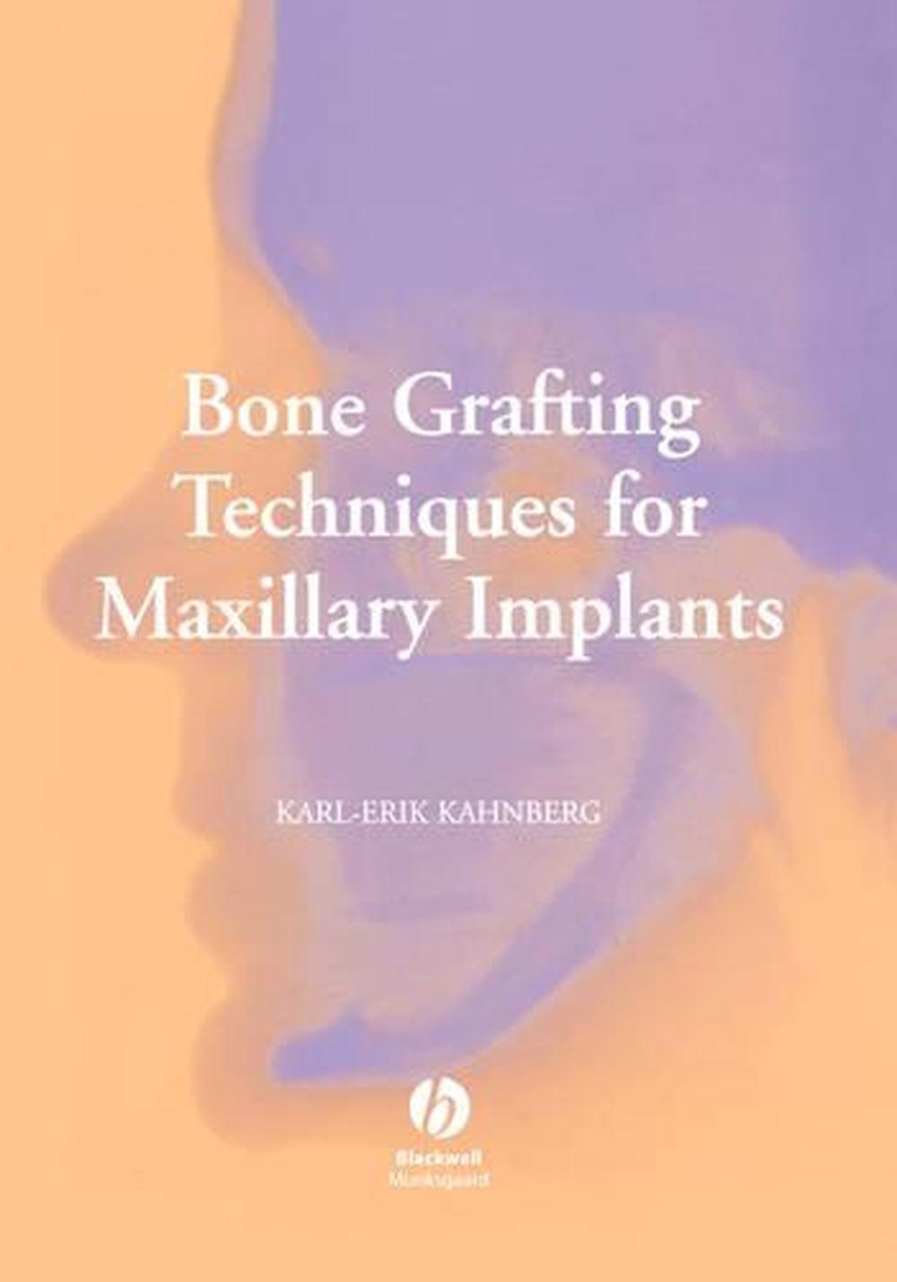 Bone Grafting Techniques for Maxillary Implants, 1st Edition, 9781405129947
