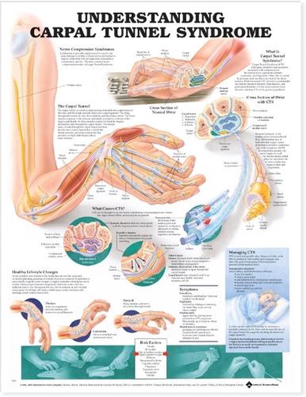 Understanding Carpal Tunnel Syndrome Anatomical Chart by Anatomical ...