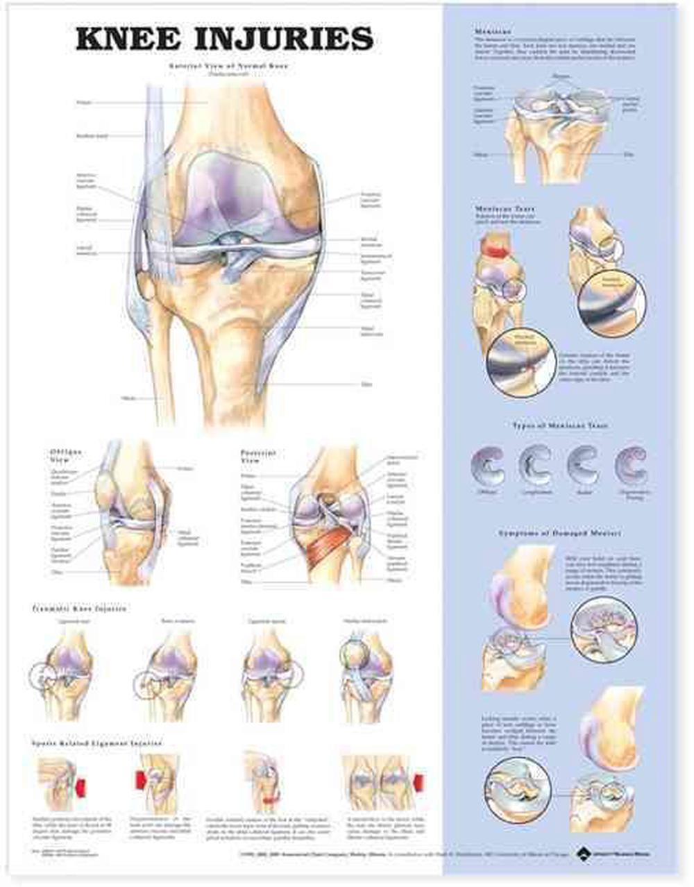 Knee Injuries Anatomical Chart By Company Knee Injuries Anatomical Chart By Company 9781587797569 Online At The Nile