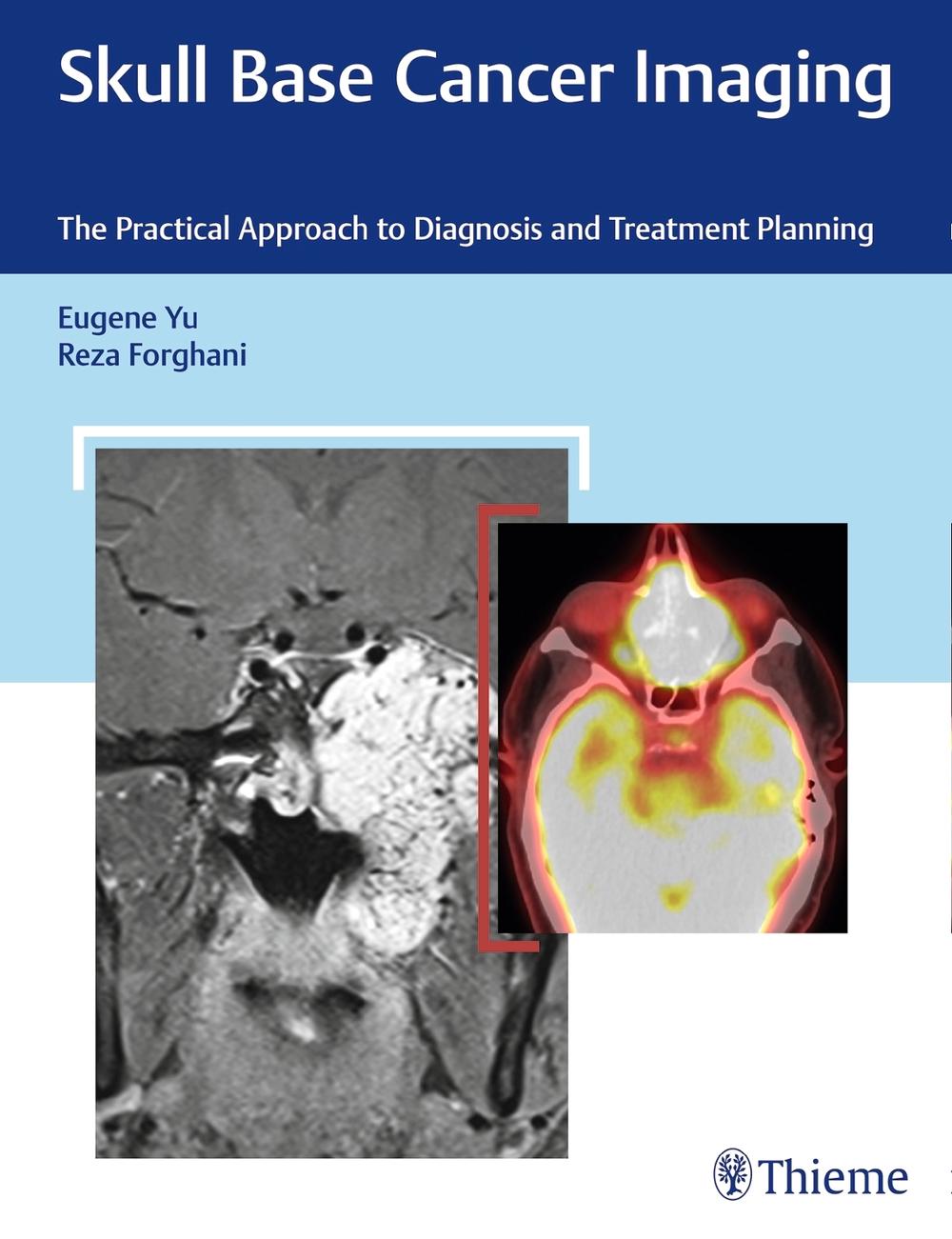 Skull Base Cancer Imaging by Eugene Yu - ISBN: 9781626232969