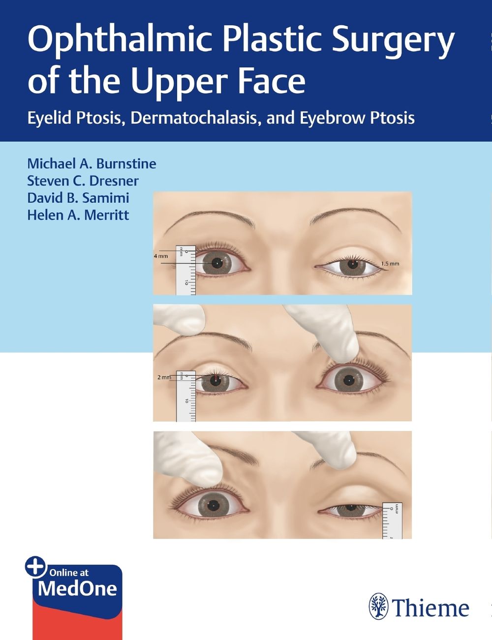 Ophthalmic Plastic Surgery of the Upper Face by Michael A. Burnstine - ISBN: 9781626239210