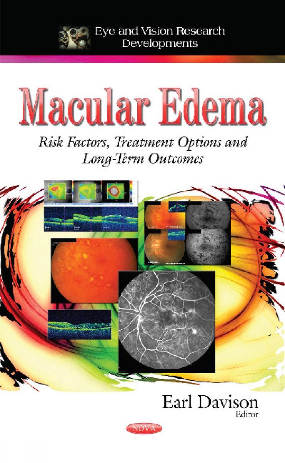 Macular Edema, 9781633215849