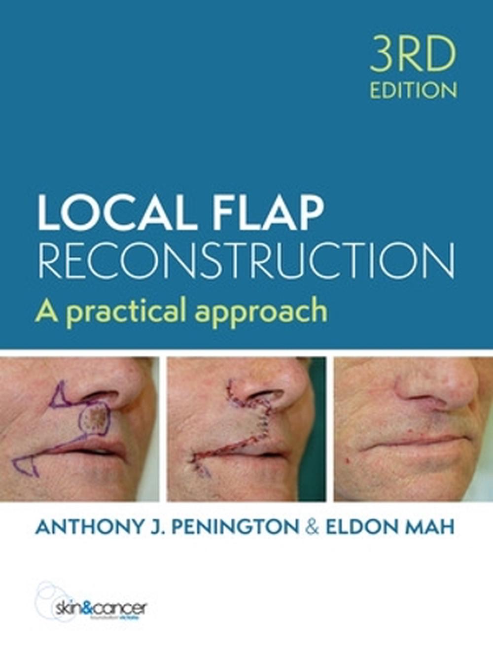 Local Flap Reconstruction, 9781743768297