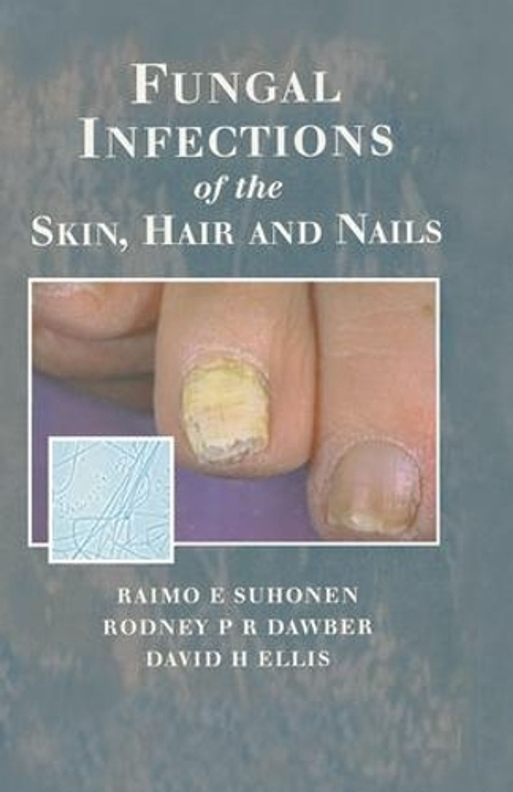 Fungal Infections of the Skin and Nails by Raimo E. Suhonen, Hardcover ...