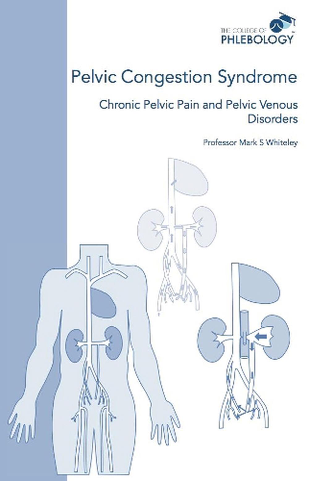 Pelvic Congestion Syndrome - Chronic Pelvic Pain and Pelvic Venous Disorders, 9781908586070