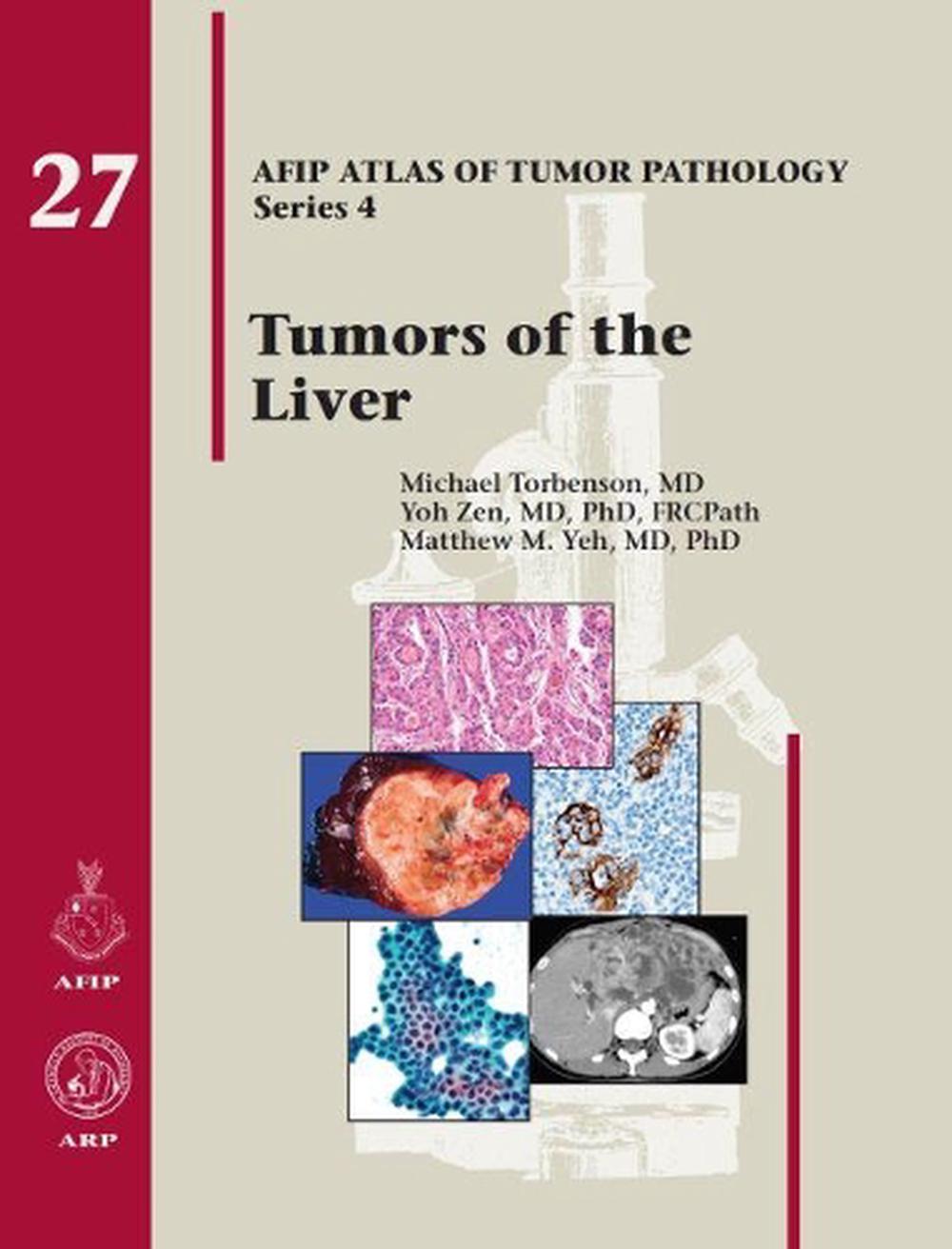 Tumors of the Liver, 9781933477411