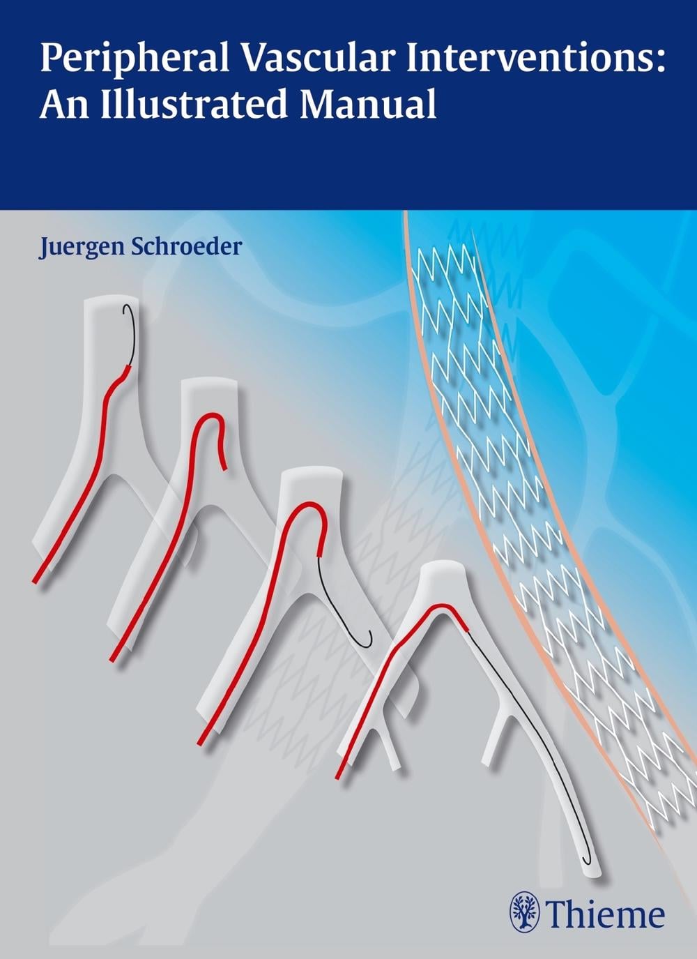 Peripheral Vascular Interventions: an Illustrated Manual by Jürgen Schröder - ISBN: 9783131697516