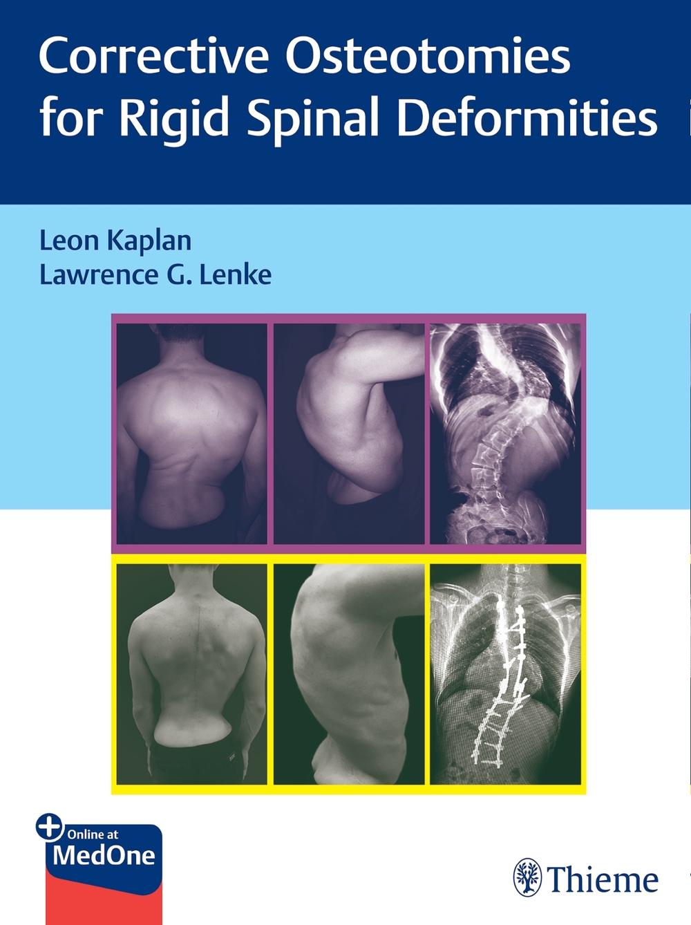 Corrective Osteotomies for Rigid Spinal Deformities by Leon Kaplan - ISBN: 9783131730817