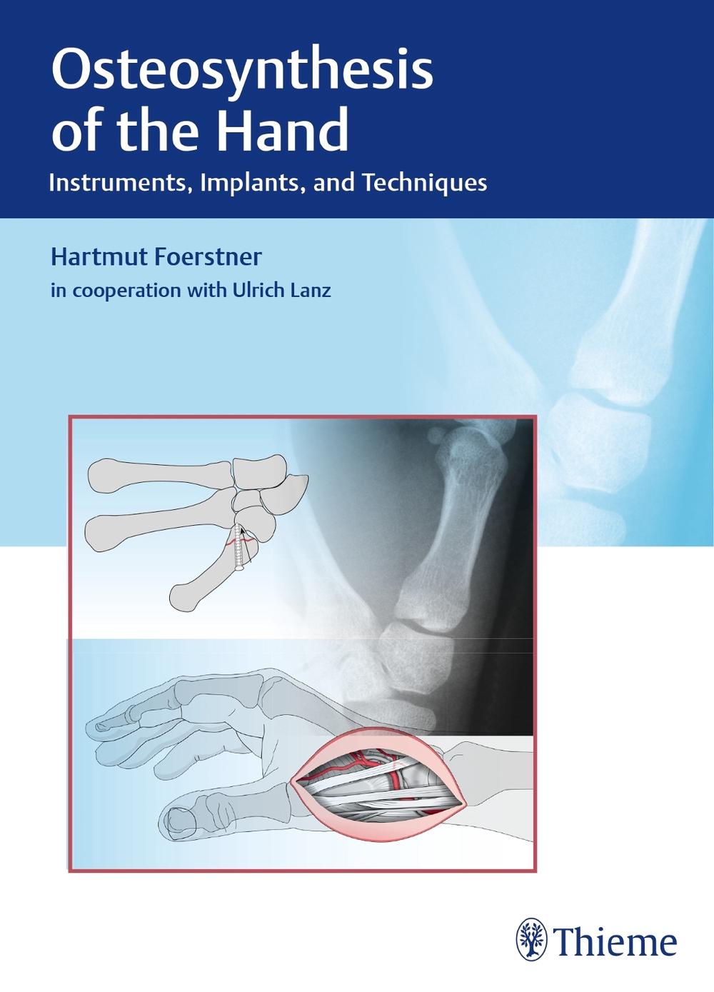 Osteosynthesis of the Hand by Hartmut Förstner - ISBN: 9783132038110