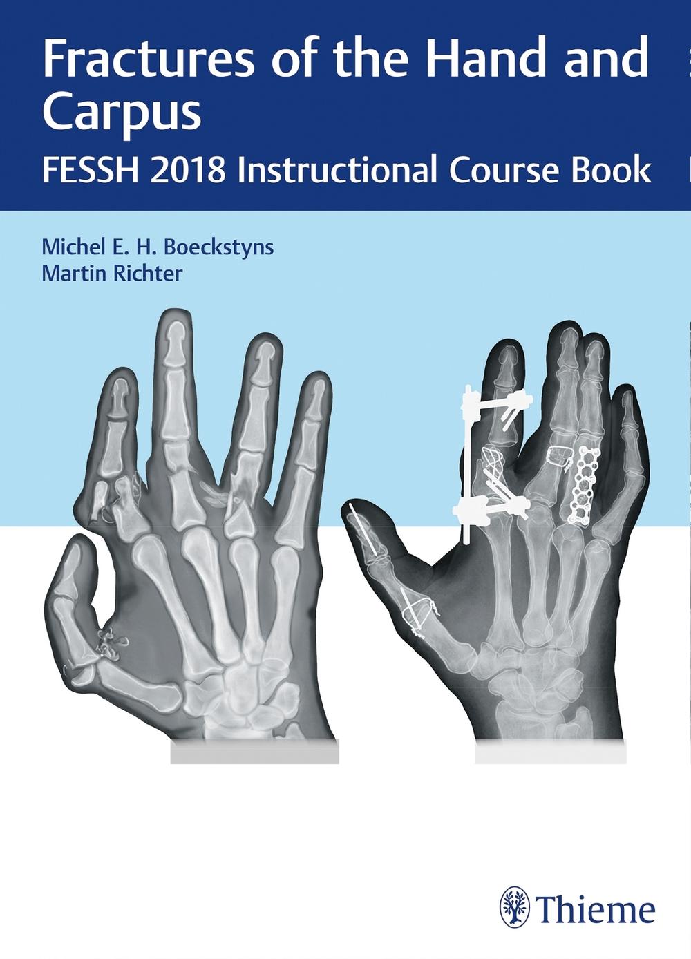 Fractures of the Hand and Carpus by Michel E.H. Boeckstyns - ISBN: 9783132417205