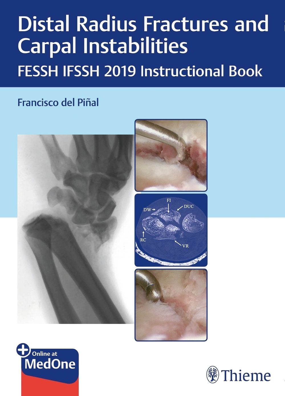 Distal Radius Fractures and Carpal Instabilities by Francisco Pinal - ISBN: 9783132423794