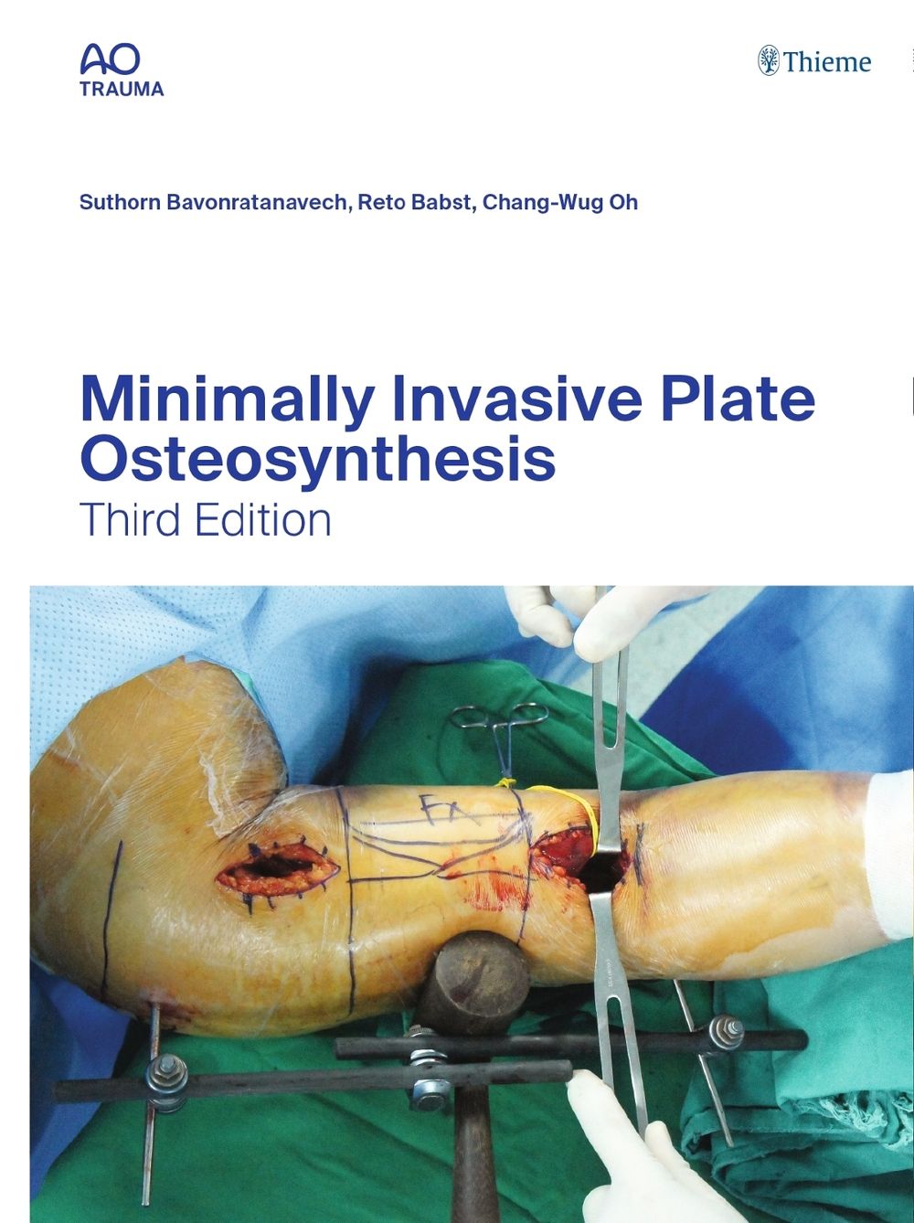 Minimally Invasive Plate Osteosynthesis by Suthorn Bavonratanavech - ISBN: 9783132454255
