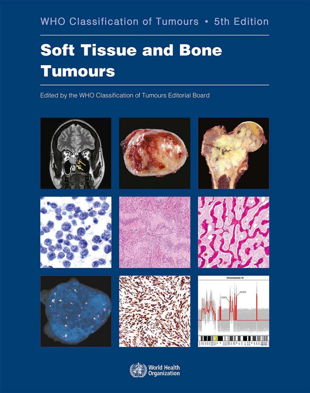 WHO classification of tumours of soft tissue and bone tumours by World ...