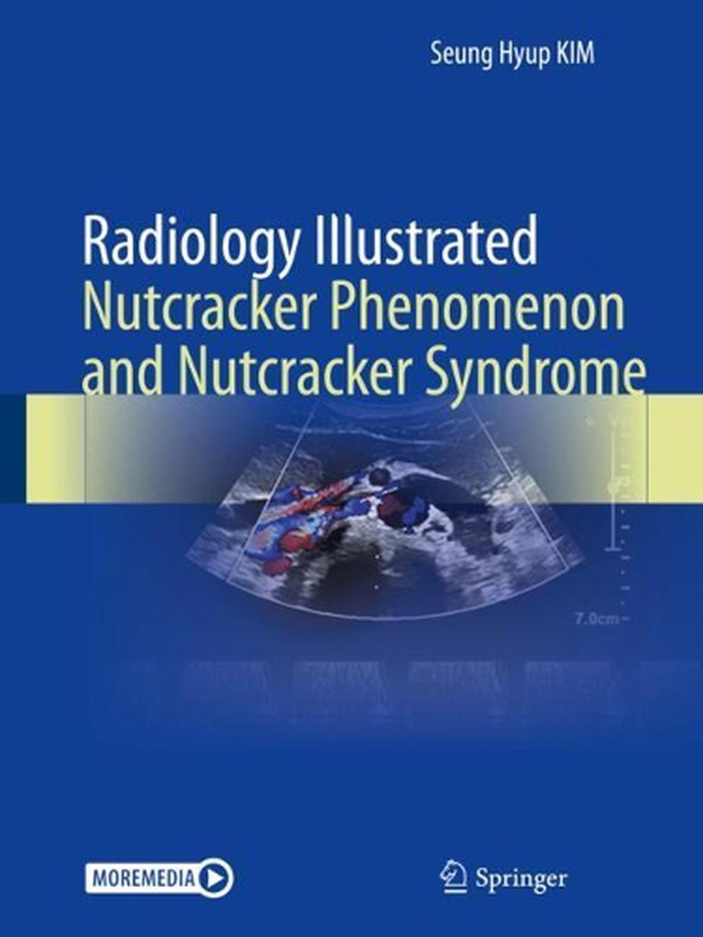 Radiology Illustrated Nutcracker Phenomenon and Nutcracker Syndrome by